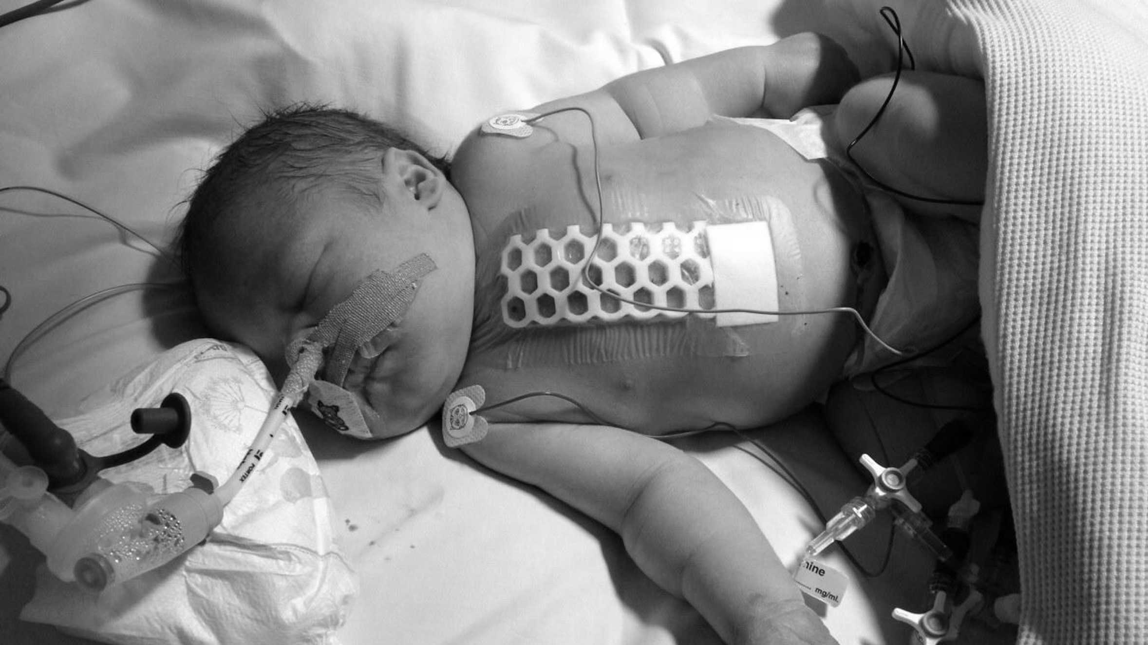 George in hospital after his first operation at only 36 hours old.